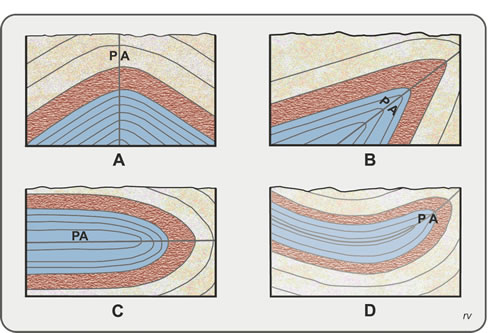 Fig. 5.11. A) anticlinal simétrico; B) anticlinal volcado; C) anticlinal recumbente; D) anticlinal recumbente replegado. Modificado de Billings, 1963.